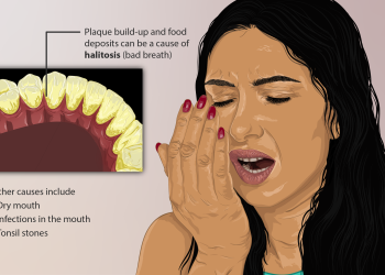 How to deal with Halitosis?