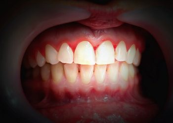 Gum Infection Treatment Singapore: Does Gum Disease Treatment Hurt?