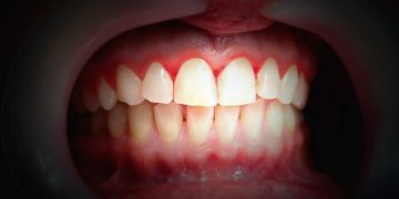 Gum Infection Treatment Singapore: Does Gum Disease Treatment Hurt?