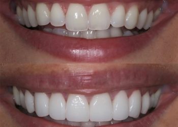 How Does Cosmetic Tooth Contouring Work? | Enhance Your Smile Today