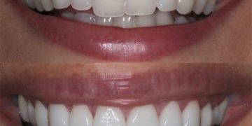 How Does Cosmetic Tooth Contouring Work? | Enhance Your Smile Today